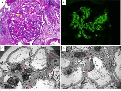 Case Report: Guillain-Barré Syndrome as Primary Presentation of Systemic Lupus Erythematosus (SLE-GBS) in a Teenage Girl